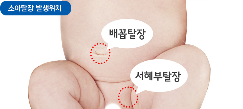 탈장의종류
